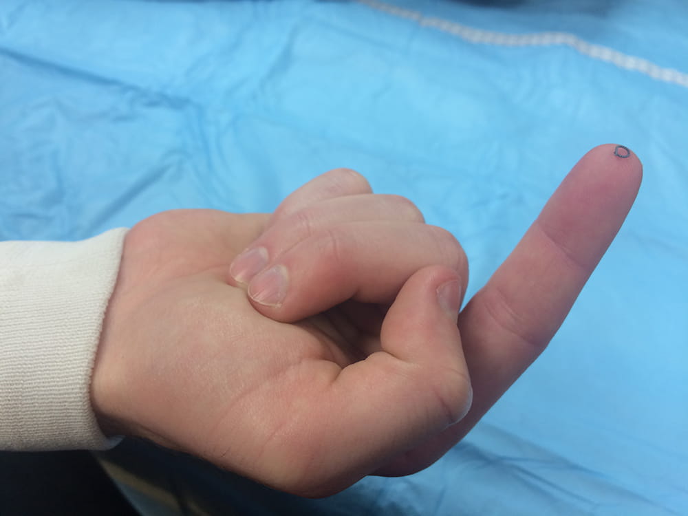 A minuscule titanium marker clip atop someone's fingertip