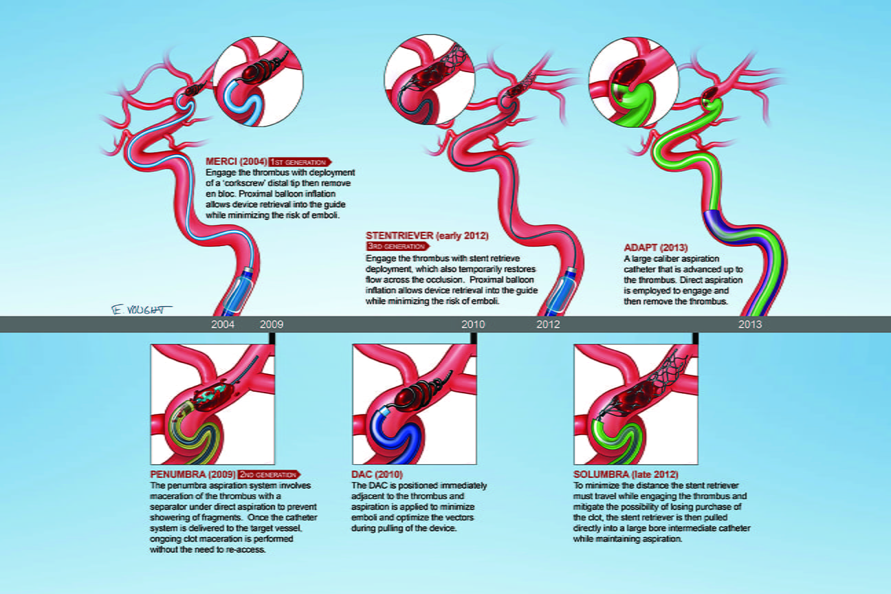 an illustration of the various ways of removing a blood clot 