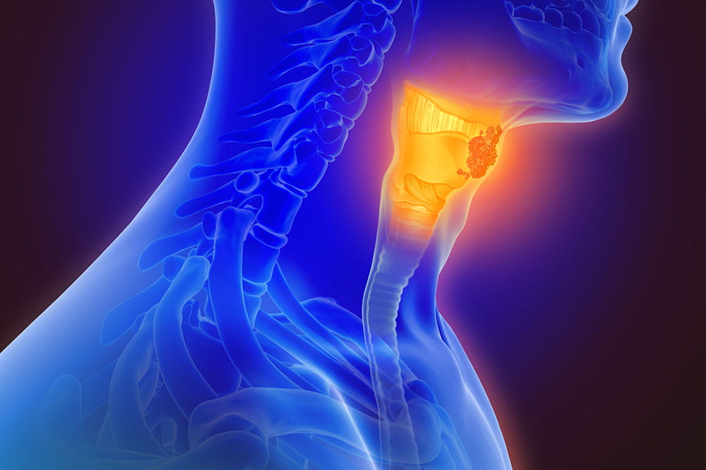 illustration of throat cancer