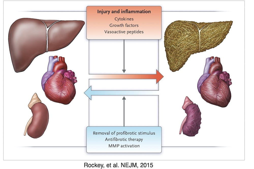 Diagram showing the potential reversibility of fibrosis. Originally published in the New England Journal of Medicine in 2015. Available at https://www.nejm.org/doi/full/10.1056/NEJMra1300575?