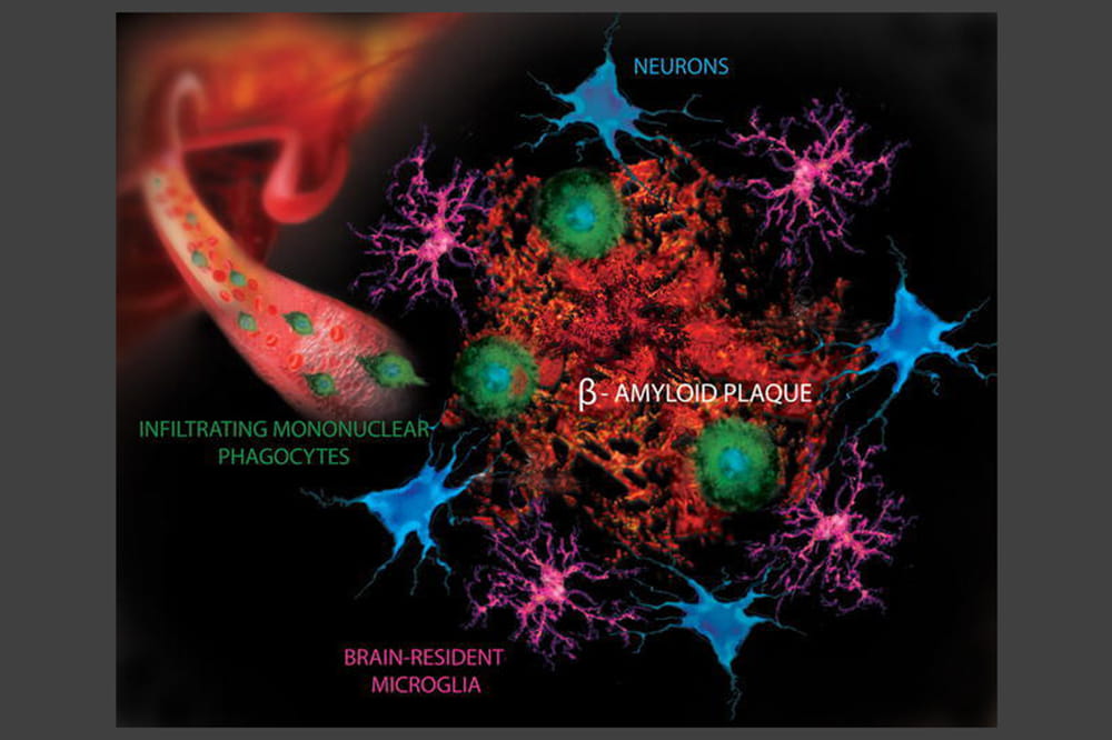 Mononuclear phagocytes in Alzheimer's disease. Licensed from Wikimedia Commons.