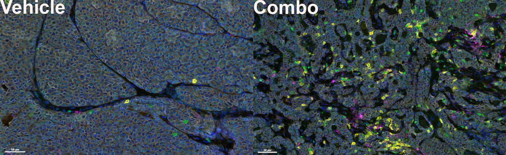 After combination therapy, many more tumor-fighting immune cells enter the tumor.  Immune cells in the tumor: T cells (green), CD8+ T cells (yellow).  