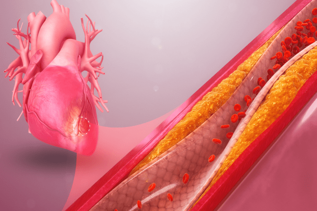 3D still showing myocardial ischemia. Licensed from http://www.scientificanimations.com, via the Creative Commons 4.0 license, available at https://creativecommons.org/licenses/by-sa/4.0/deed.en